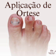 A rafa Soares tem a solução para problemas com encravamentos e fungos nas unhas, a correção do formato das unhas com problema crônico é com aplicação de órteses