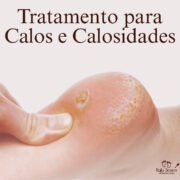 Calos incomodam demais muitas pessoas, e a Rafa Soares tem a solução certa para esse problema, cuidado indolor e rápido para ter os pés novinhos em folha novamente