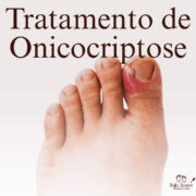 Chega de unha encravada, a Rafa Soares realiza todo o cuidado necessário para te salvar desse incomodo sem dor e com muito cuidado