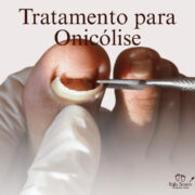 Unhas que se soltam sozinhas pode doer muito, mas a Rafa Soares tem o tratamento correto pra isso, chega de dor e sofrimento